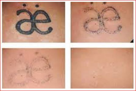 How Long Does Laser Tattoo Removal Take | Apps Directories